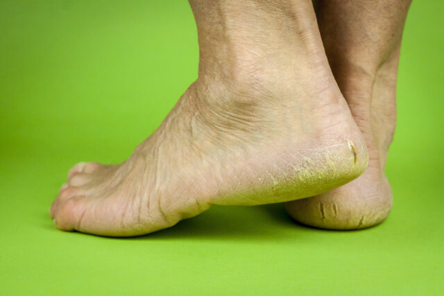 praskliny na pätách