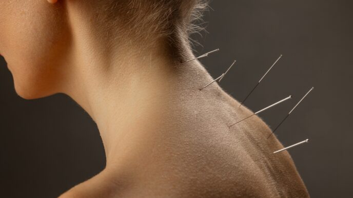 Akupunktúra