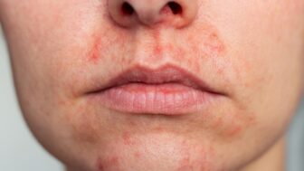 periorálna dermatitída