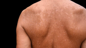 pityriasis versicolor