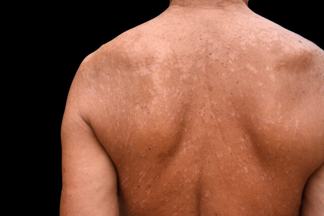 pityriasis versicolor