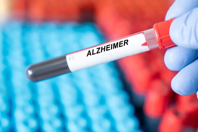 Alzheimer a krvná vzorka