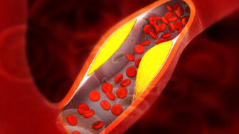 ilustrácia vysokého cholesterolu