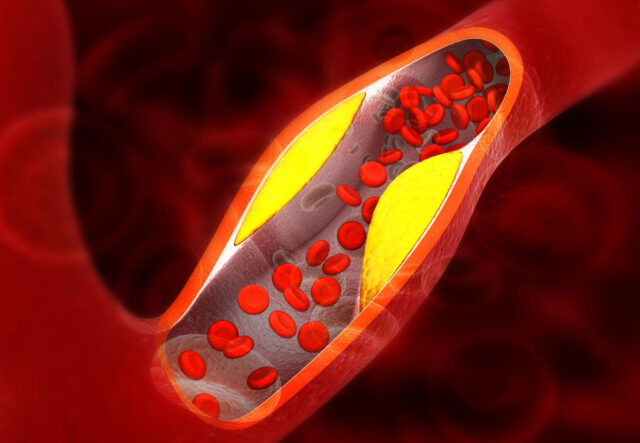 ilustrácia vysokého cholesterolu