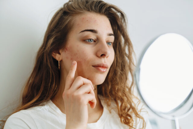 Young woman with problem skin looking into mirror