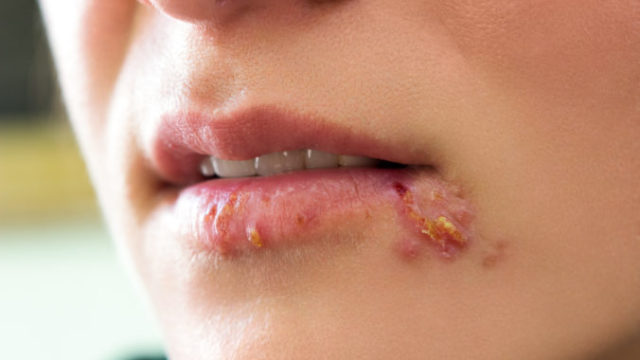 488515_herpes zena pera 676x451.jpg