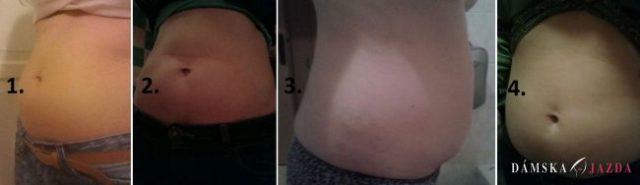 Liposukcia bruška, súťažná anketa, 3. týždeň