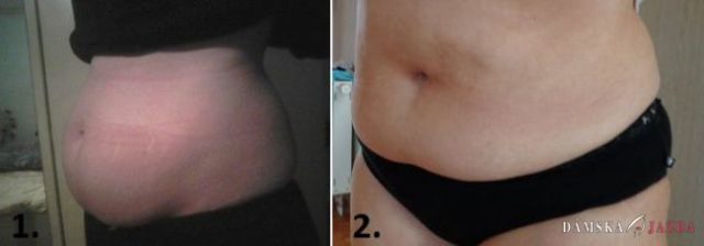 Liposukcia bruška, súťažná anketa, 4. týždeň