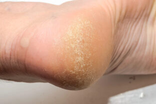 tvrdá koža na pätách