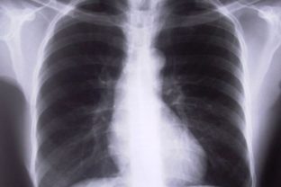 Röntgen hrudníka