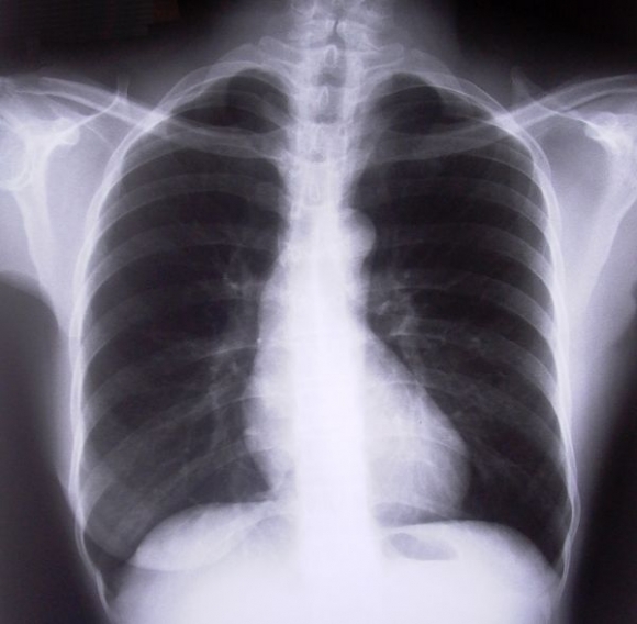 Röntgen hrudníka