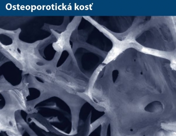 Osteoporoticka kost