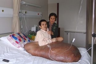 Vo Vietname operovali muža s obrovským nádorom