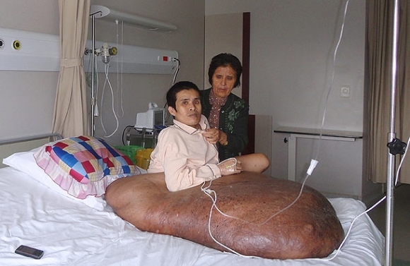 Vo Vietname operovali muža s obrovským nádorom