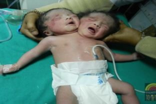 V Indii sa narodili siamské dvojčatá