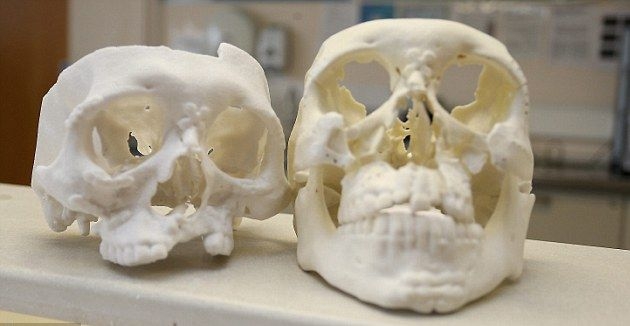 Muž si zlomil 26 kostí v lebke, vďaka 3D tlačiari má novú tvár