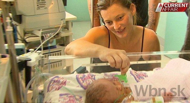 Austrálčanka porodila dvojičky s jedným telom a dvoma mozgami
