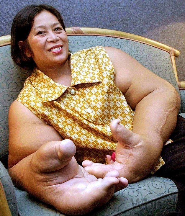 Thajčanka má najväčšie ruky na svete, spolu vážia 19 kg