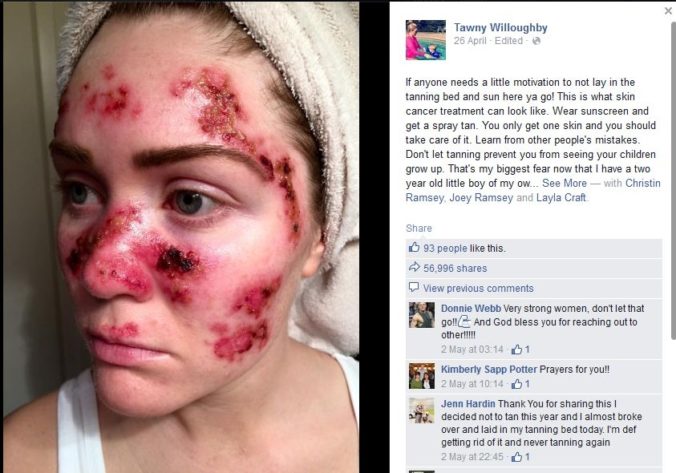 Žena uverejnila hrozivú selfie, odrádza ľudí od solárií