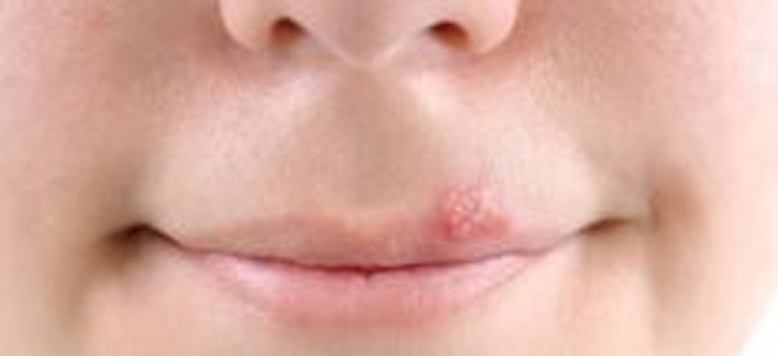 Trápi vás herpes? Takto sa ho môžete zbaviť.