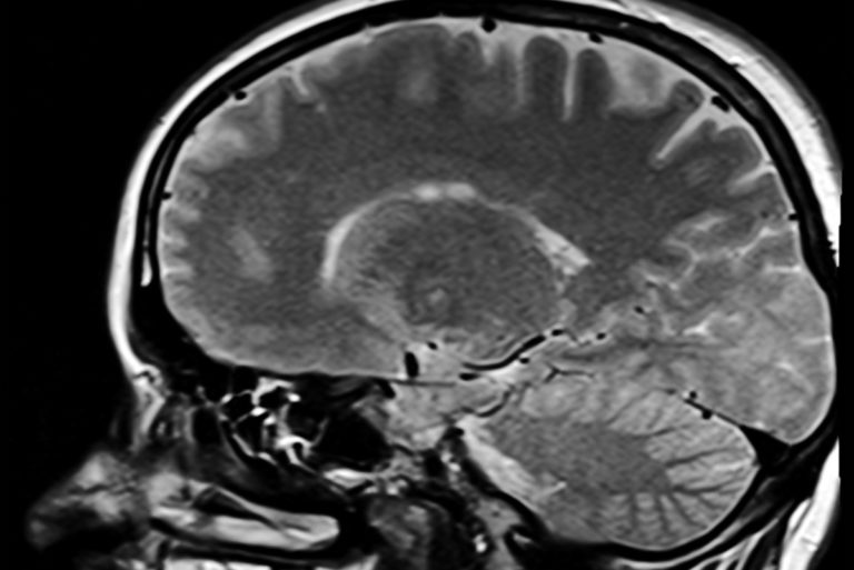 Mozog_mri.jpg