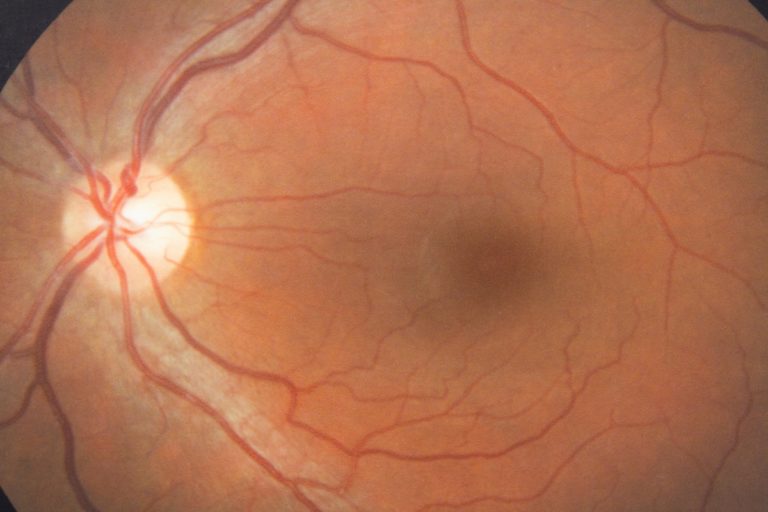 Angiogram