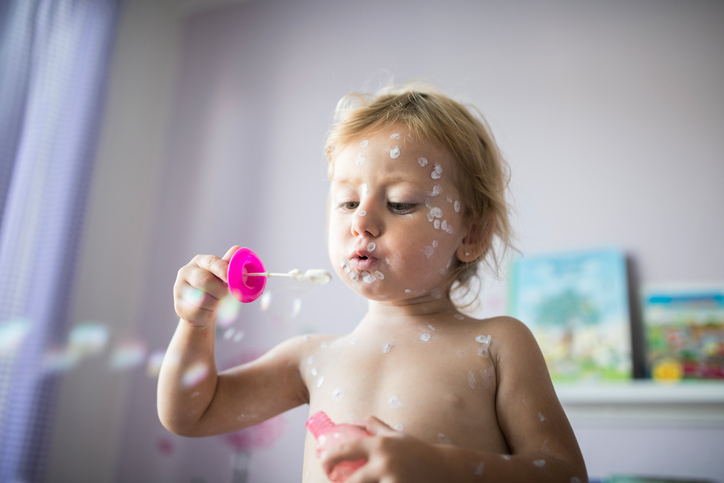 Little girl with chickenpox, antiseptic cream applied to the ras