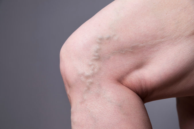 Varicose veins closeup. Thick female legs