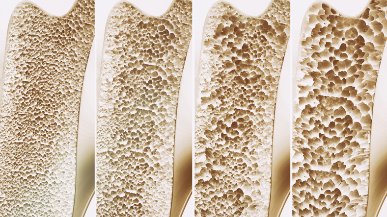 Osteoporóza, rednutie kostí, kosti