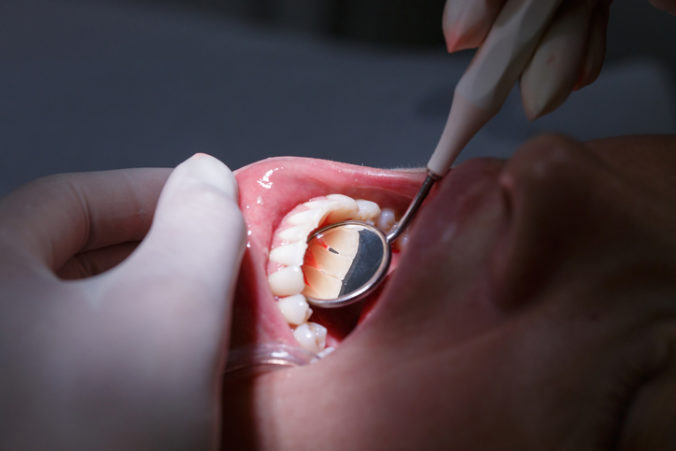 Dôležitá je správna starostlivosť o zuby.