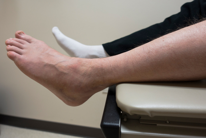 Broken Foot, Sprained Ankle, Fractured Bone in Doctor&#039;s Exam Room