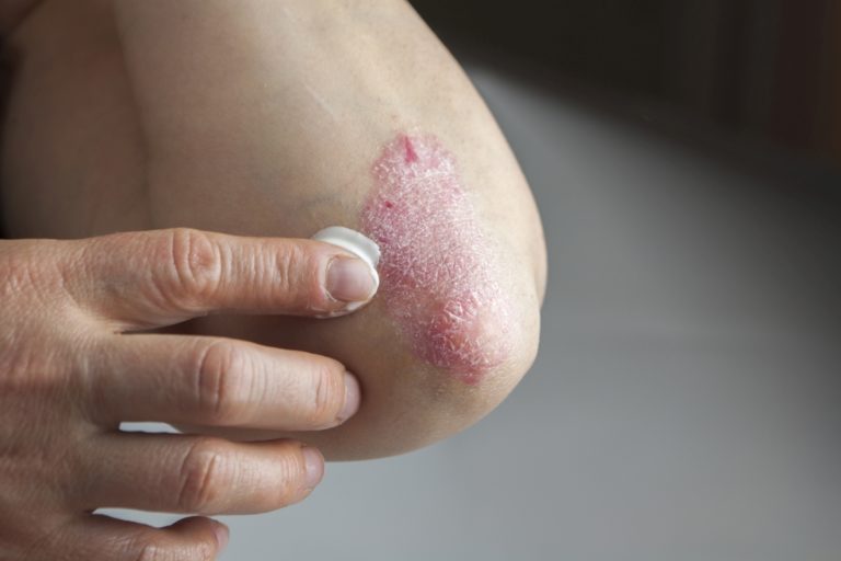 Psoriaza