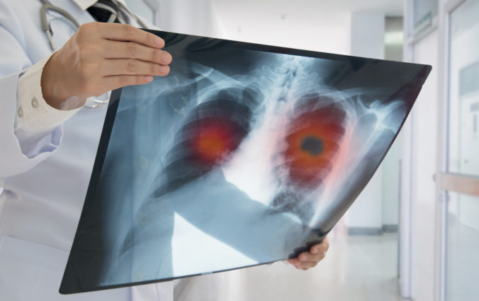 X ray lung cancer