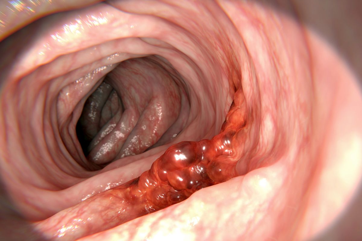 Colorectal cancer