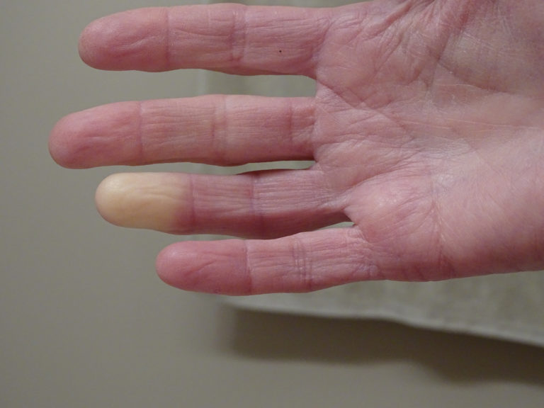 Raynaud’s Syndrome
