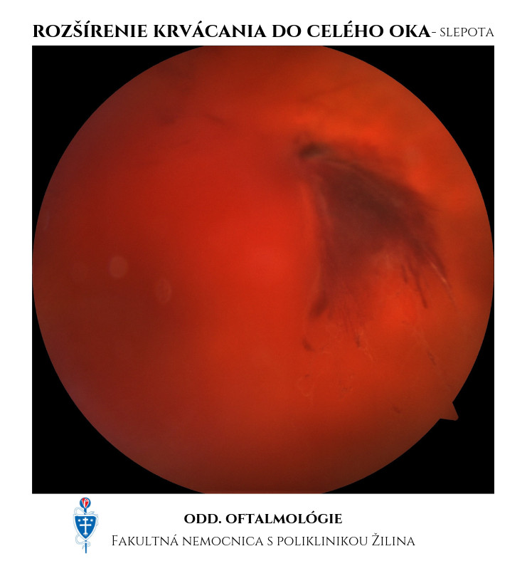 krvácanie do oka