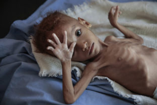 podvýživa, Jemen