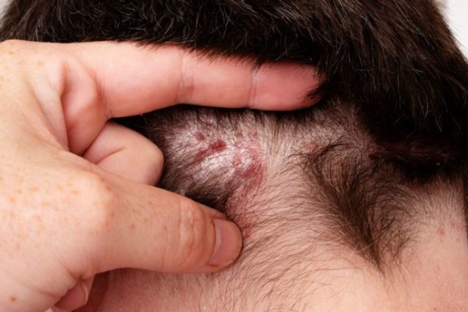 psoriáza