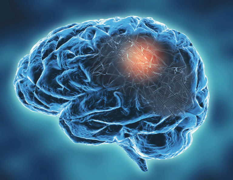 Neurodegeneratívne ochorenie, Parkinsonova choroba, mozog
