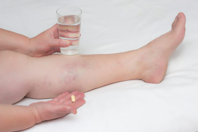 A woman is holding a pill for treating varicose veins on her legs and a glass of water, drugs for the treatment of thrombophlebitis, close up