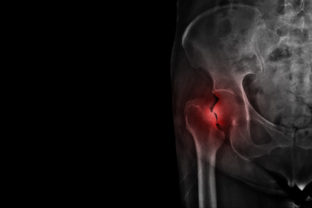 Osteoporóza, zlomenina bedrovej kosti, zlomenina stehennej kosti