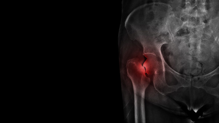 Osteoporóza, zlomenina bedrovej kosti, zlomenina stehennej kosti