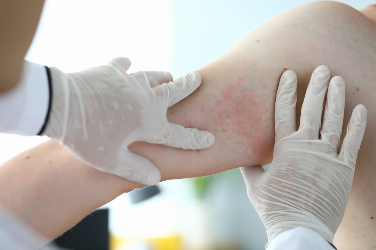 Close up examination by doctor, allergic rash.