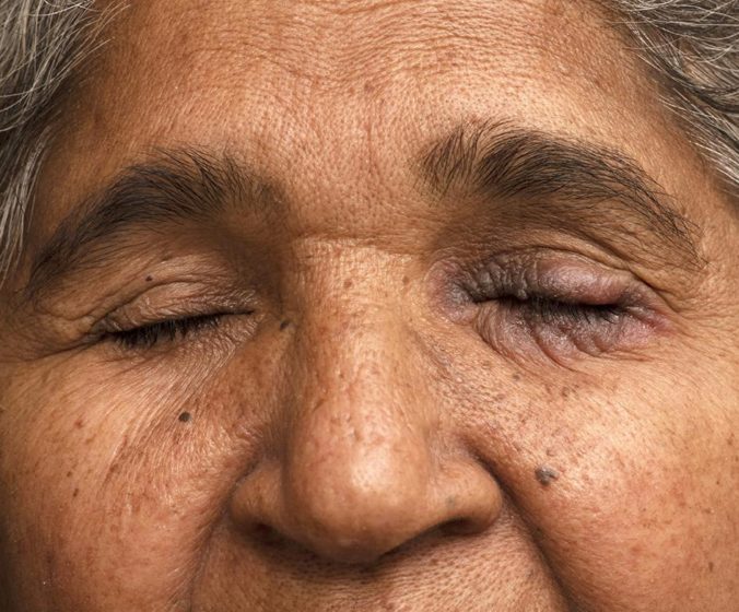 Alergická kontaktná dermatitída