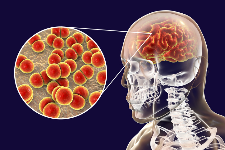 Brain infection with Neisseria meningitidis bacteria