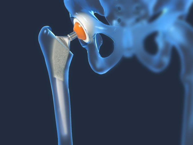 Function of a hip joint implant or hip prosthesis in frontal vie