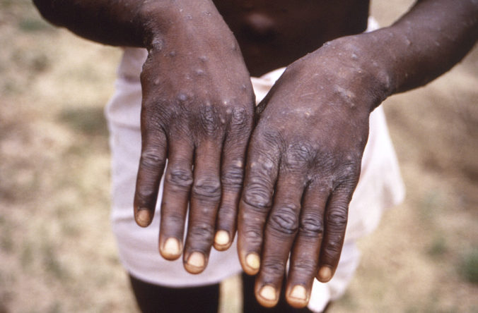Europe Monkeypox This 1997 image provided by the CDC during an investigation into an outbreak of monkeypox, which took place in the Democratic Republic of the Congo (DRC), formerly Zaire, and depicts the dorsal surfaces of the hands of a monkeypox case patient, who was displaying the appearance of the characteristic rash during its recuperative stage. As more cases of monkeypox are detected in Europe and North America in 2022, some scientists who have monitored numerous outbreaks in Africa say they are baffled by the unusual disease's spread in developed countries.