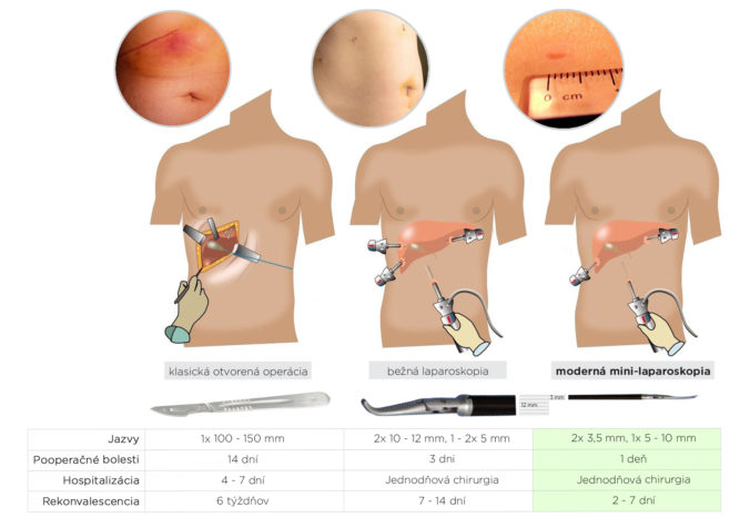 Minilaparoskopicks operscia vrhody frais.jpg