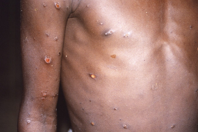 Monkeypox Opičie kiahne