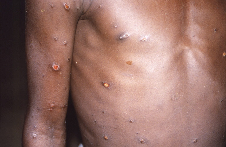 Monkeypox Opičie kiahne